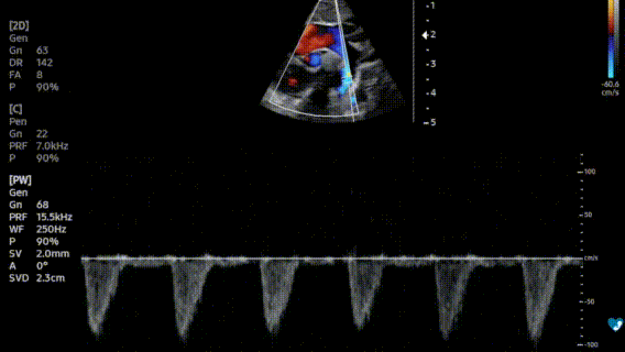 Ecocardiografia pediatrica – Doppler pulsato